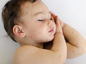 5-Effective-Treatments-To-Cure-Bug-Bites-In-Babies