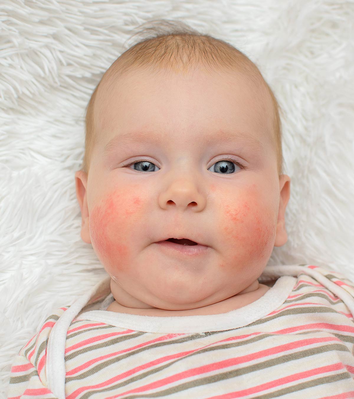 婴儿对鸡蛋过敏的12种症状及其治疗