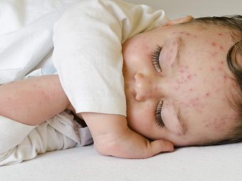 Chickenpox-In-Babies-SymptomsTreatment-And-Prevention