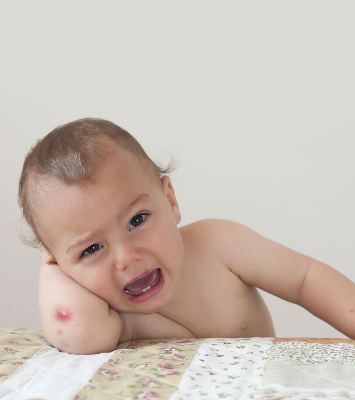 婴儿身上的疖子:症状、原因、治疗和家庭疗法