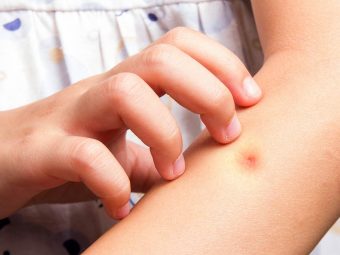 7种治疗儿童蚊虫叮咬的方法