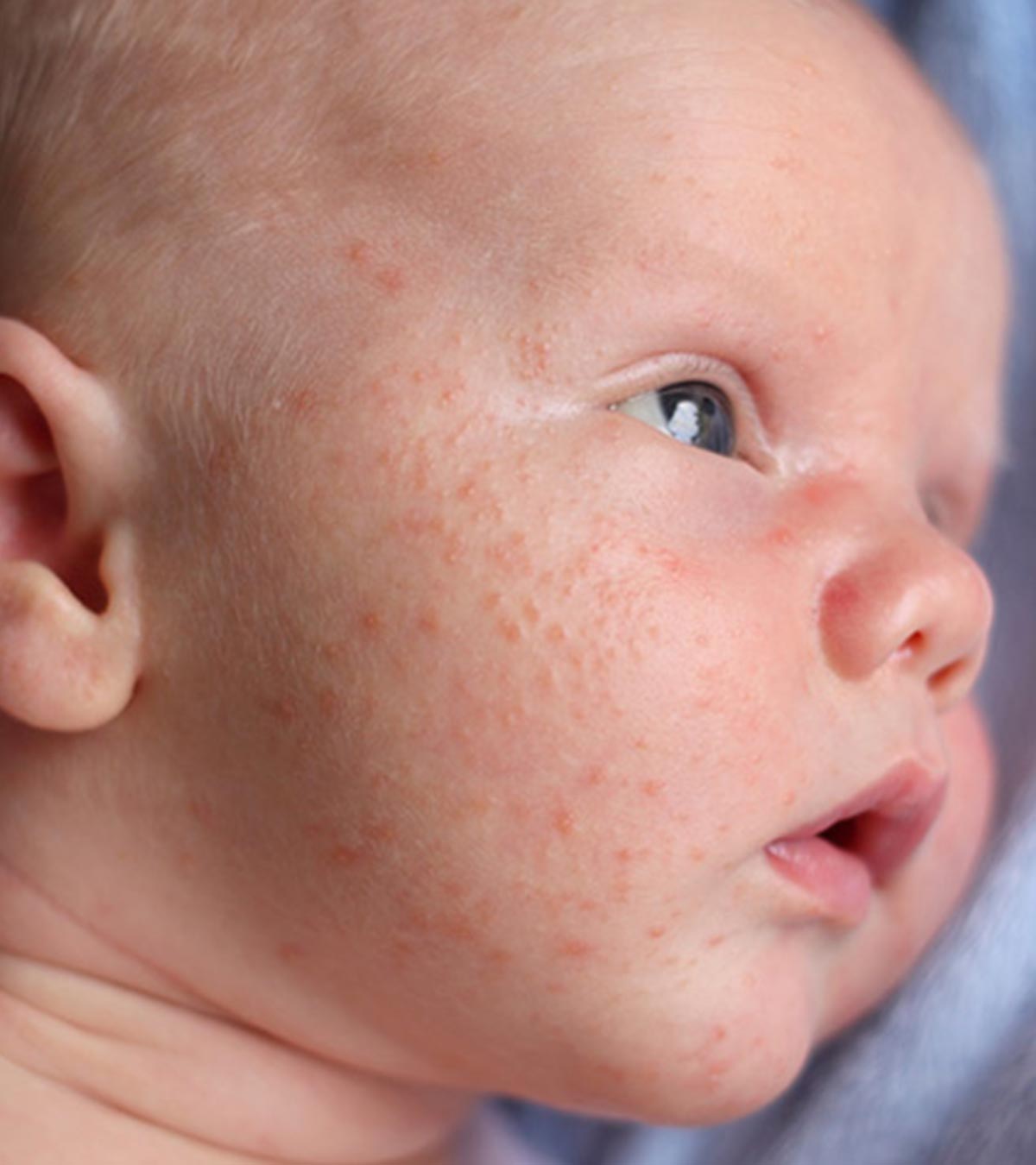 婴儿痤疮:原因，症状和如何摆脱它