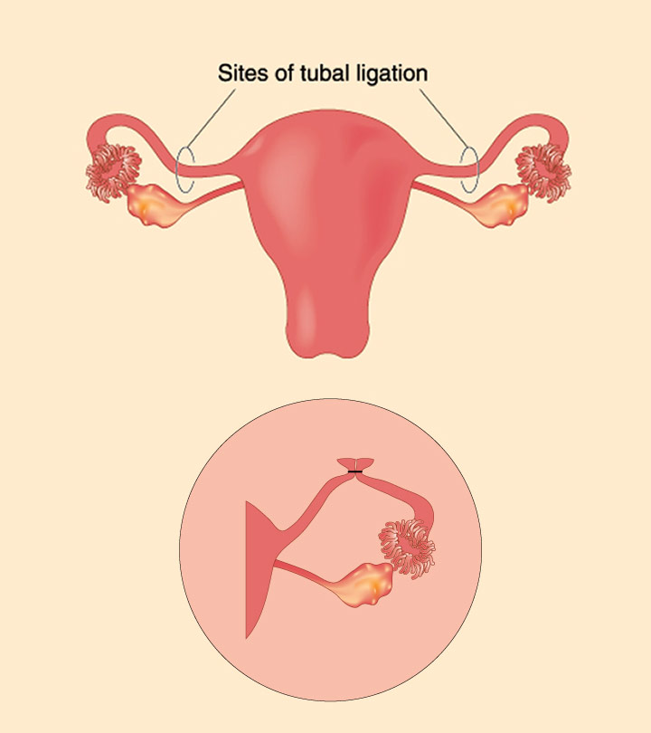 输卵管结扎后妊娠的症状及风险