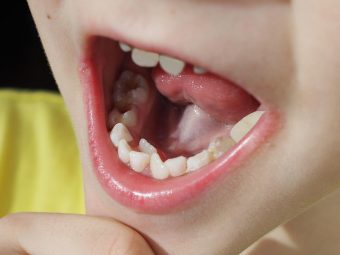 儿童多牙症的6个原因及治疗方法