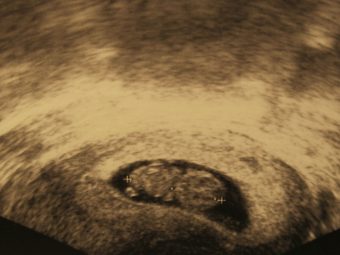 Ultrasound-Baby-Development