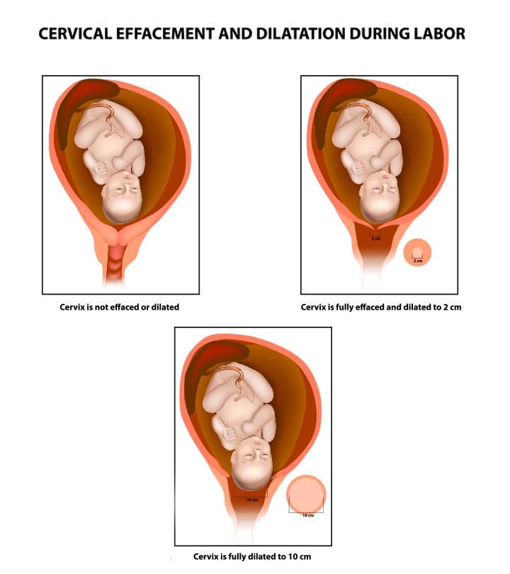 宫颈扩张图:体征、阶段和检查程序