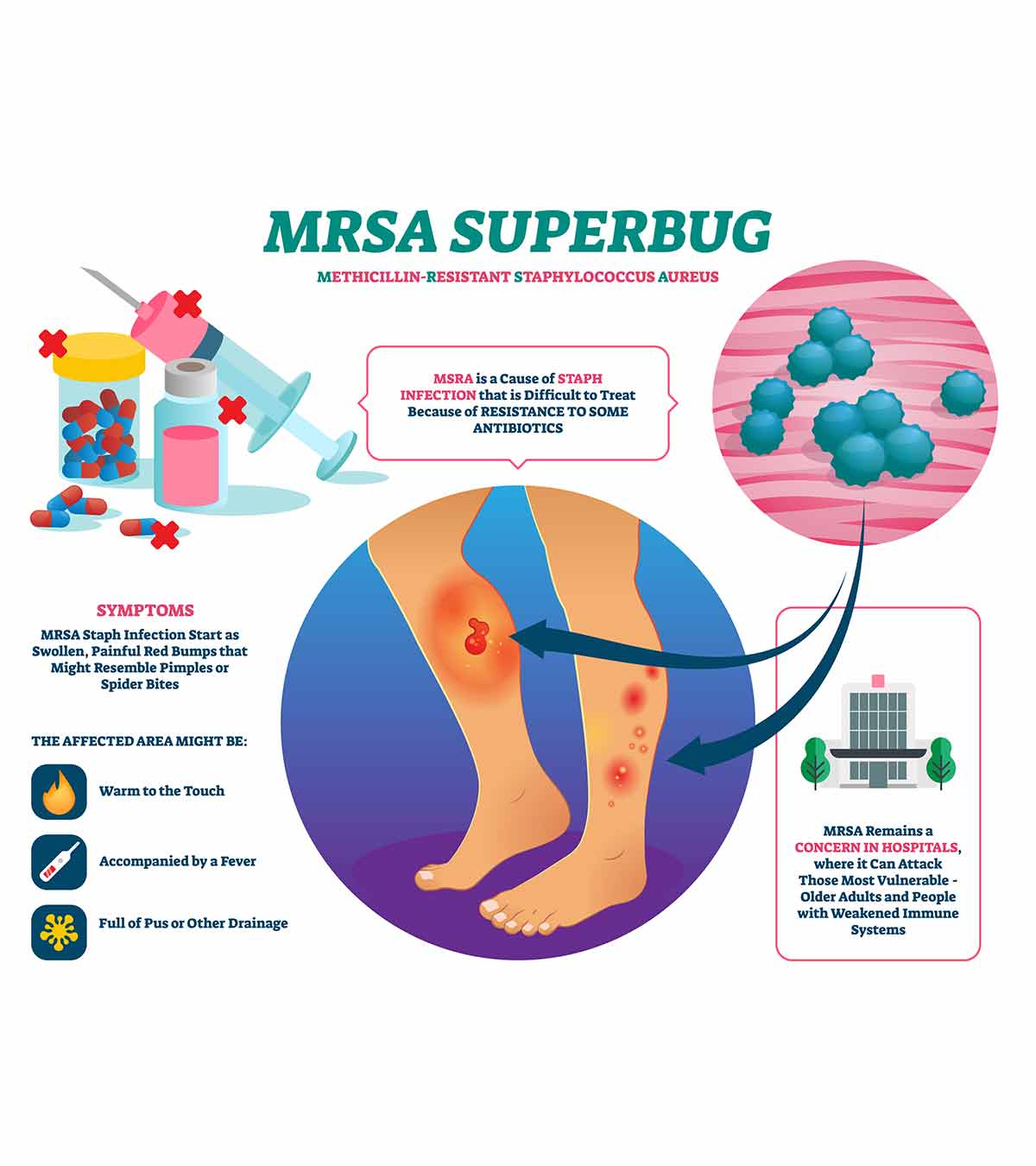 儿童MRSA感染:原因、症状、治疗和风险