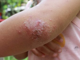 What Causes Psoriasis In Children And How To Deal With It?