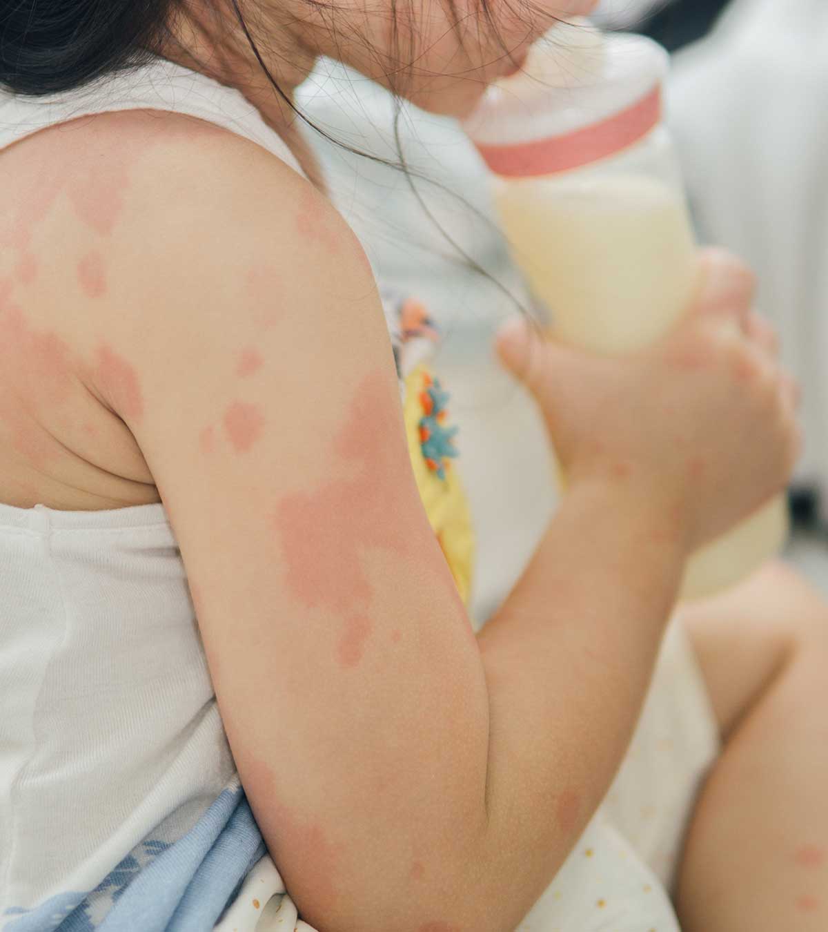 儿童牛奶过敏的6个重要迹象和原因
