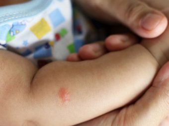婴儿被跳蚤叮咬的样子、治疗和预防