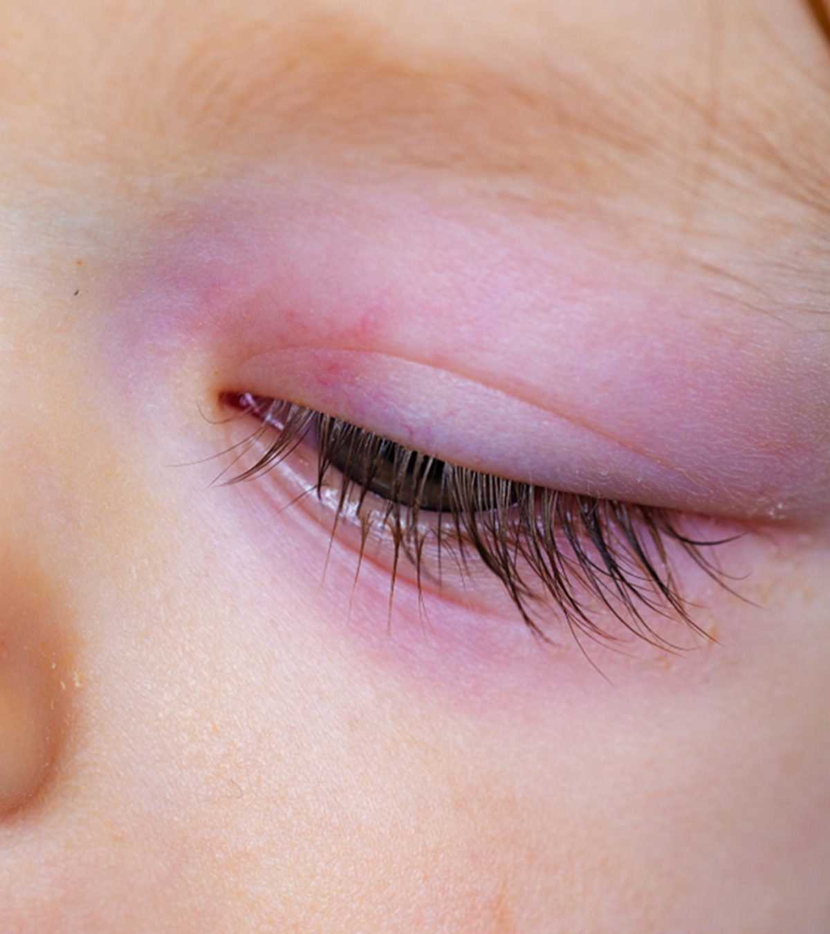 婴儿眼睛肿胀:原因，家庭疗法和治疗