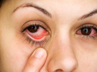 妊娠期结膜炎(红眼)