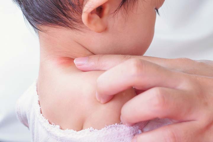 婴儿可能会因为对乙酰氨基酚的副作用而出现皮疹