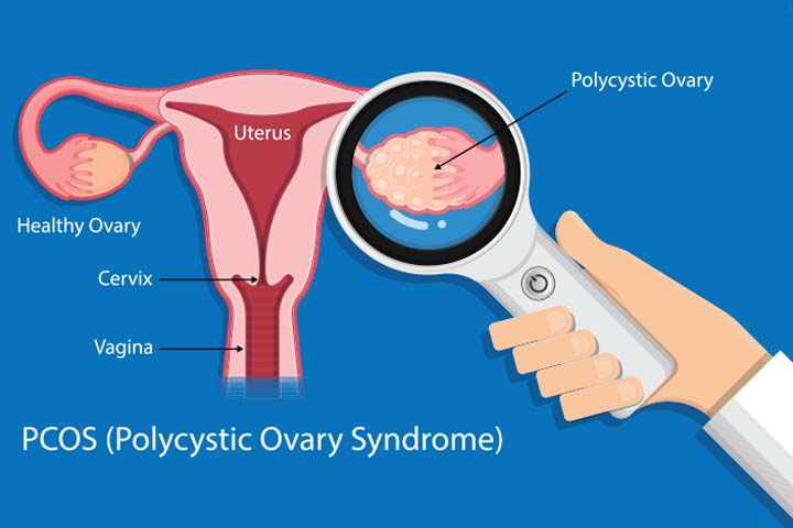 二甲双胍可用于多囊卵巢综合征妇女的生育治疗