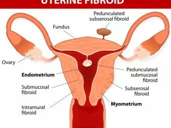 5代用tive Treatments To Cure Uterine Fibroids During Pregnancy