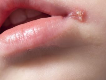 Cold-Sores-In-Babies-CausesSymptoms-And-Treatment