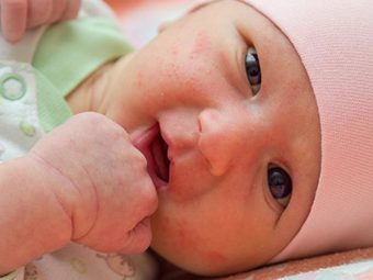 Scarlet Fever In Babies And Toddlers 9 Answers You Must Know