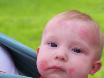 4 Causes Of Ringworm In Babies And 12 Preventive Measures