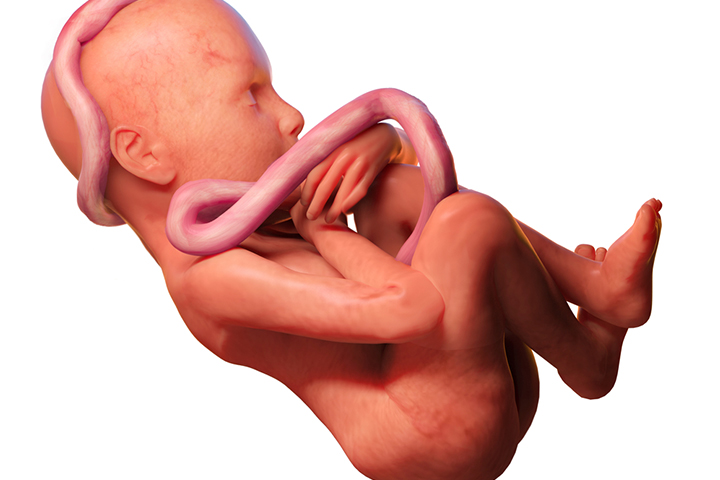 Transverse position of the fetus can cause twisting of the umbilical cord