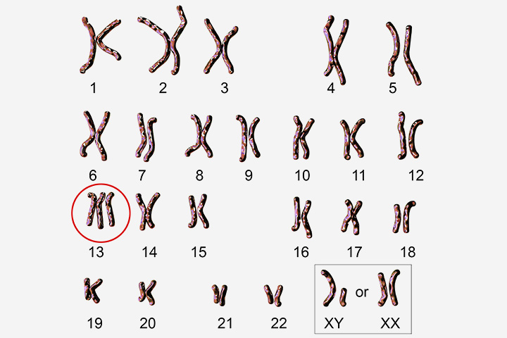 Patau syndrome in babies with extra chromosomes