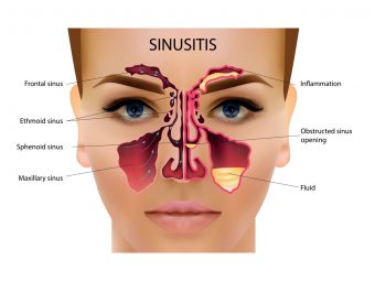 Sinus Infection When Breastfeeding