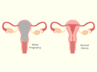 Molar Pregnancy Symptoms, Causes And Treatment