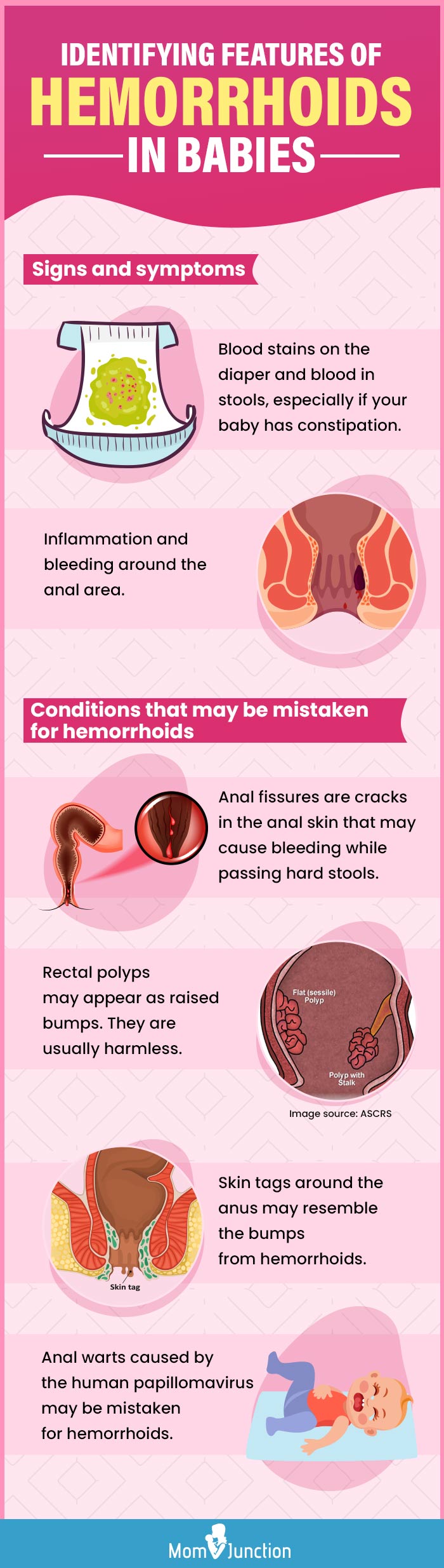 identifying features of hemorrhoids in babies (infographic)