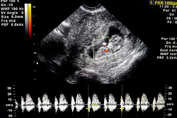 Cord prolapse can cause complications with the fetal heart rate