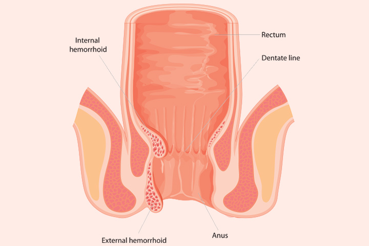 Formation of hemorrhoids in babies