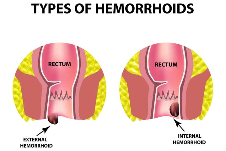 Types of postpartum hemorrhoids