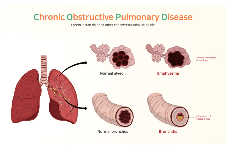 Progressive inflammatory lung disease