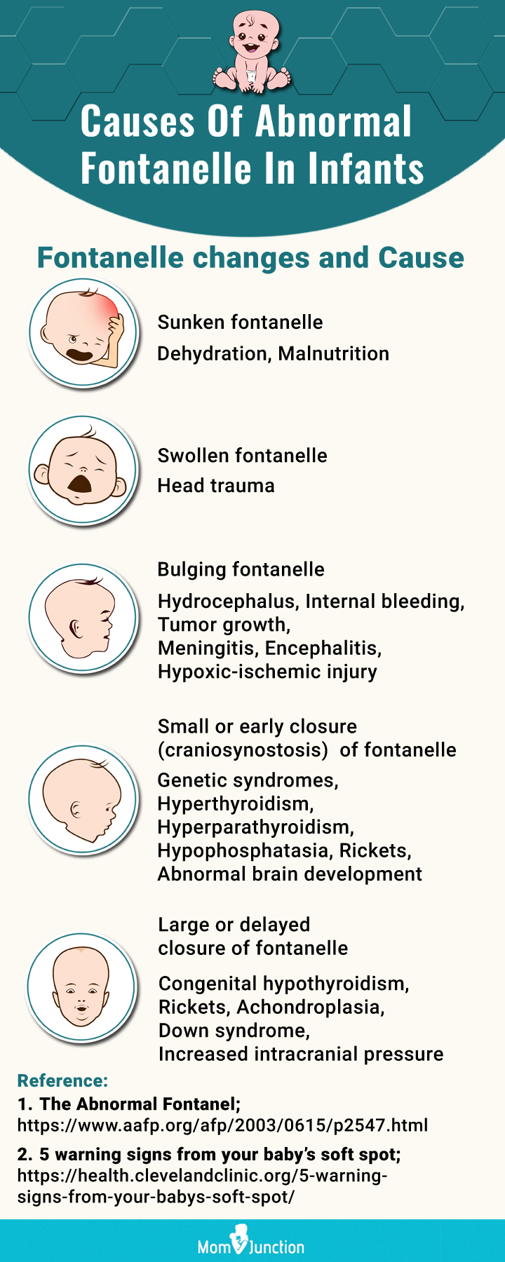 baby sunken fontanelle (infographic)