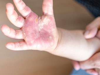 Burns In Children Treatment, Home Remedies And Prevention