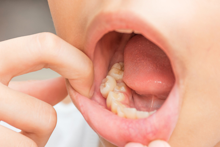 Untimely eruption of primary teeth may affect the alignment of permanent teeth