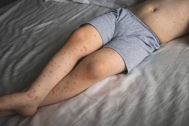 Viral rash in children, roseola
