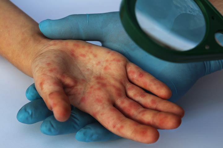 Viral rash in children, hand, foot and mouth disease