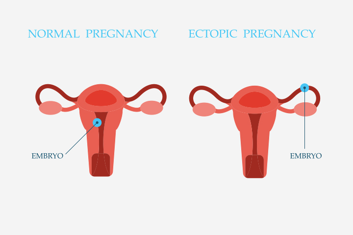 Ectopic pregnancy could cause cysts