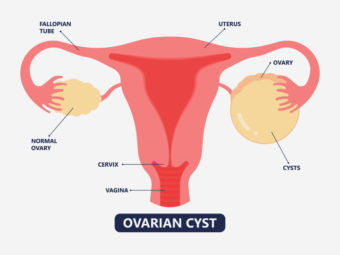 Pregnant With Ovarian Cysts