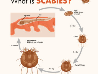Symptoms Of Scabies In Children, Treatment, And Prevention