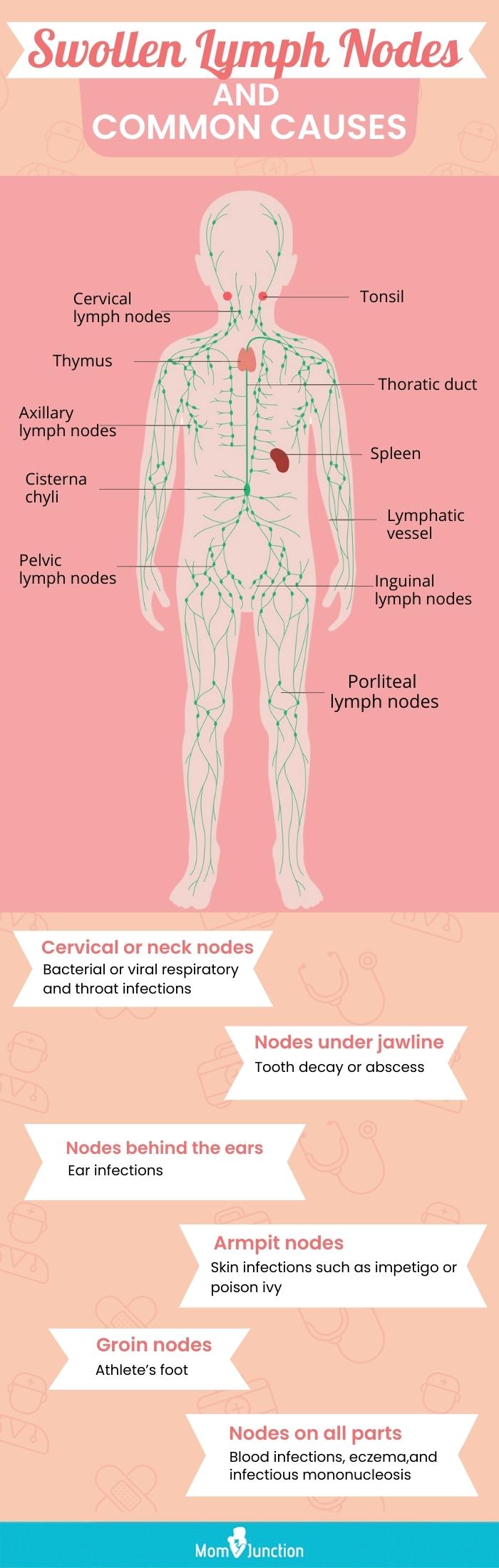 swollen lymph nodes and common causes (infographic)
