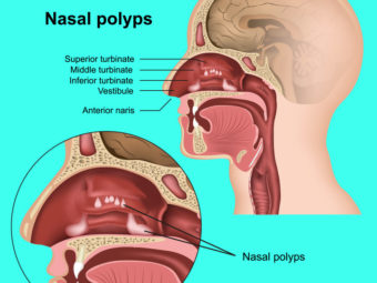 Nasal Polyposis In Children Causes, Symptoms, Treatment And Prevention