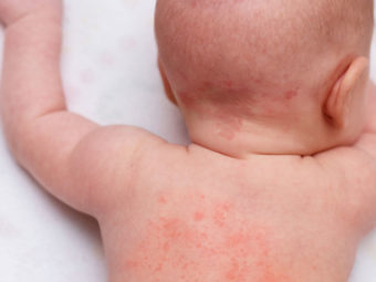 Heat Rash In Babies Types, Symptoms, Treatment And Prevention