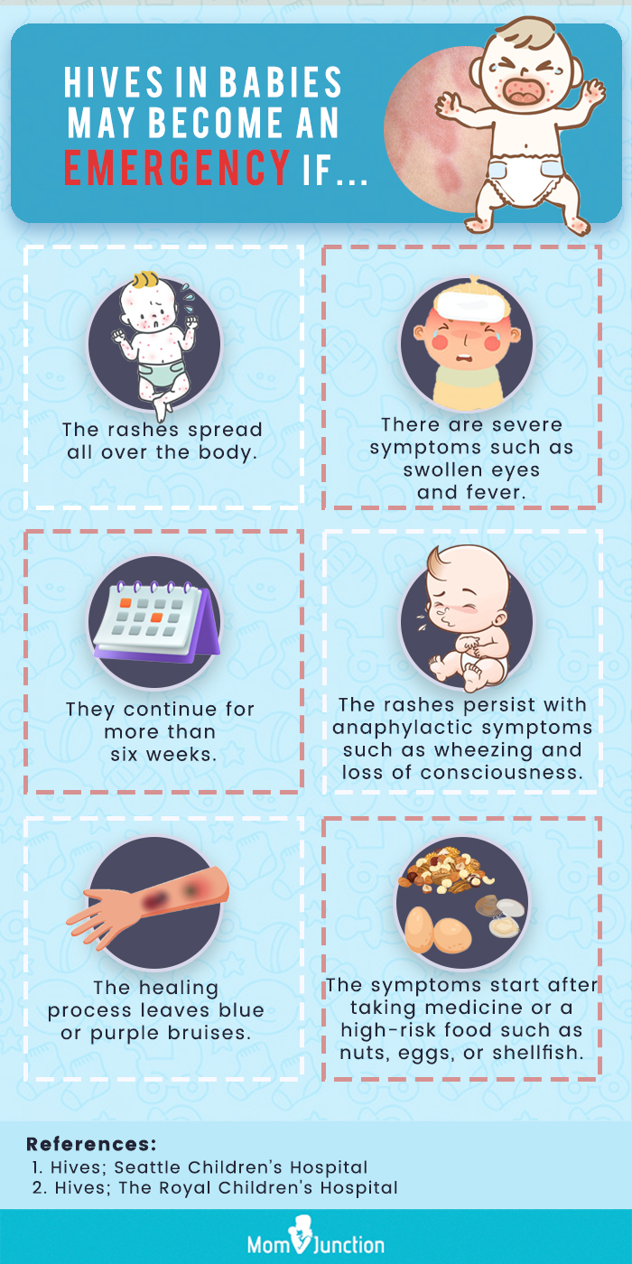 hives in babies may become emergency (infographic)