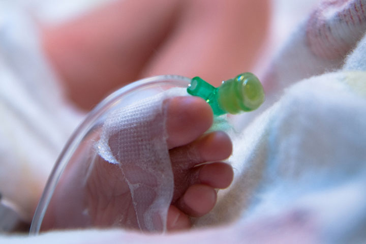 IV fluid administration to a premature infant