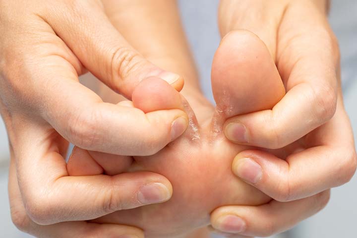 Athlete’s foot can cause hard and white patches