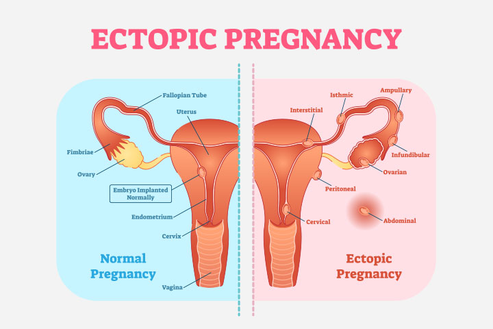 Ectopic pregnancy, Viable/ Non-Viable Pregnancy