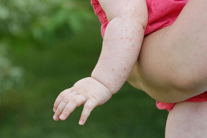 Eczema can make babies prone to milk allergy