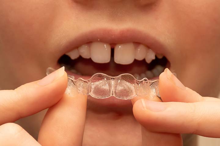 Invisalign helps correct buck teeth in kids.