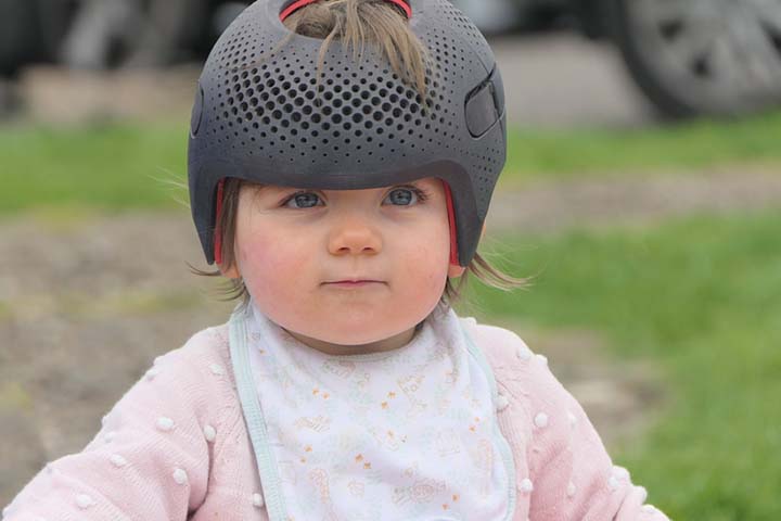 Plagiocephaly helmets can help babies with flat head syndrome