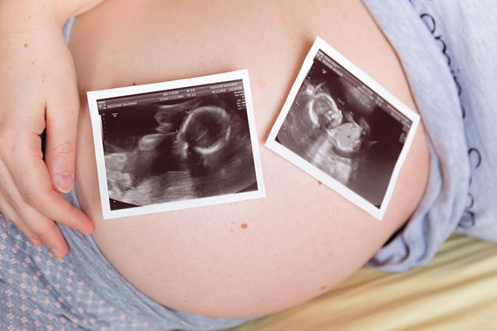 The incidence of two-vessel cord is higher in twin pregnancies